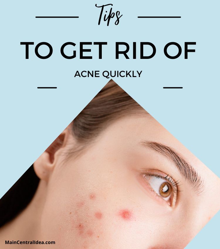Tips Get Rid Of Acne Quickly